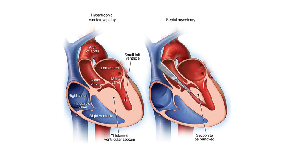 Septal Myectomy