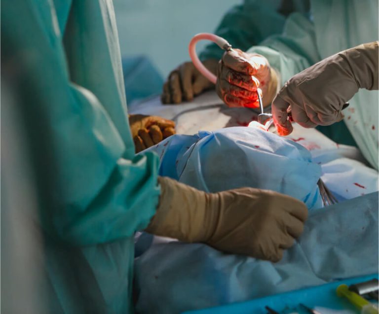 How Coronary Bypass Surgery works for your entire immunity?