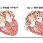 Heart Valve Repair Surgery: What Patients Should Expect