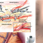 Robotic Heart Surgery in India: Advancements and Benefits