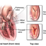 Valve Replacement and Repair