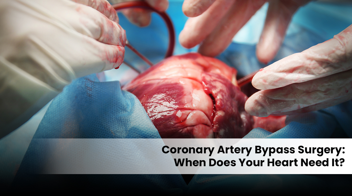 CABG bypass surgery in Gurgaon